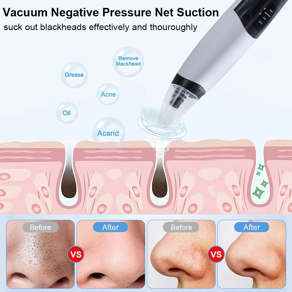 Electric Blackhead Remover Pore Vacuum – Deep Pore Cleansing & Acne Extraction Device