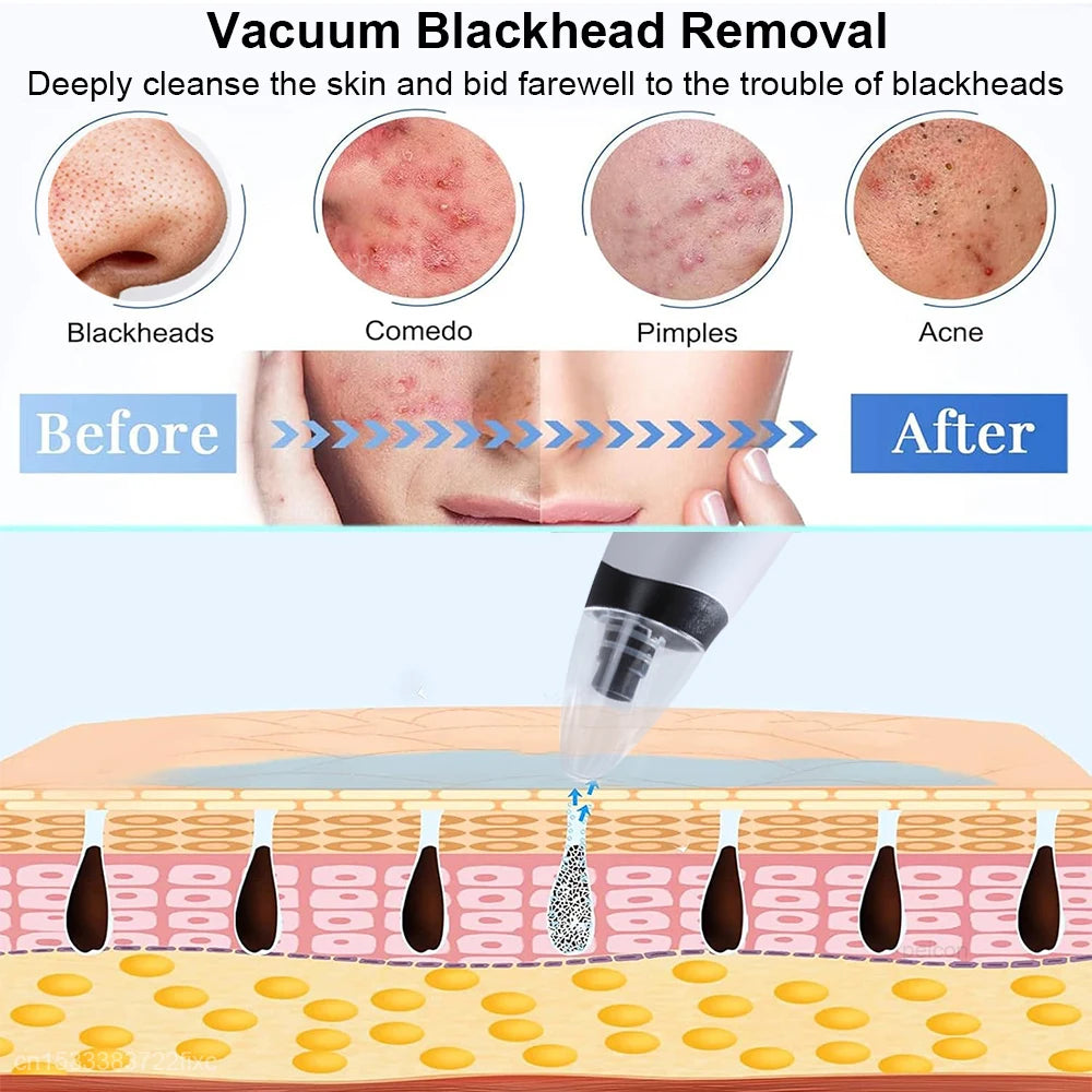 Electric Blackhead Remover Pore Vacuum – Deep Pore Cleansing & Acne Extraction Device