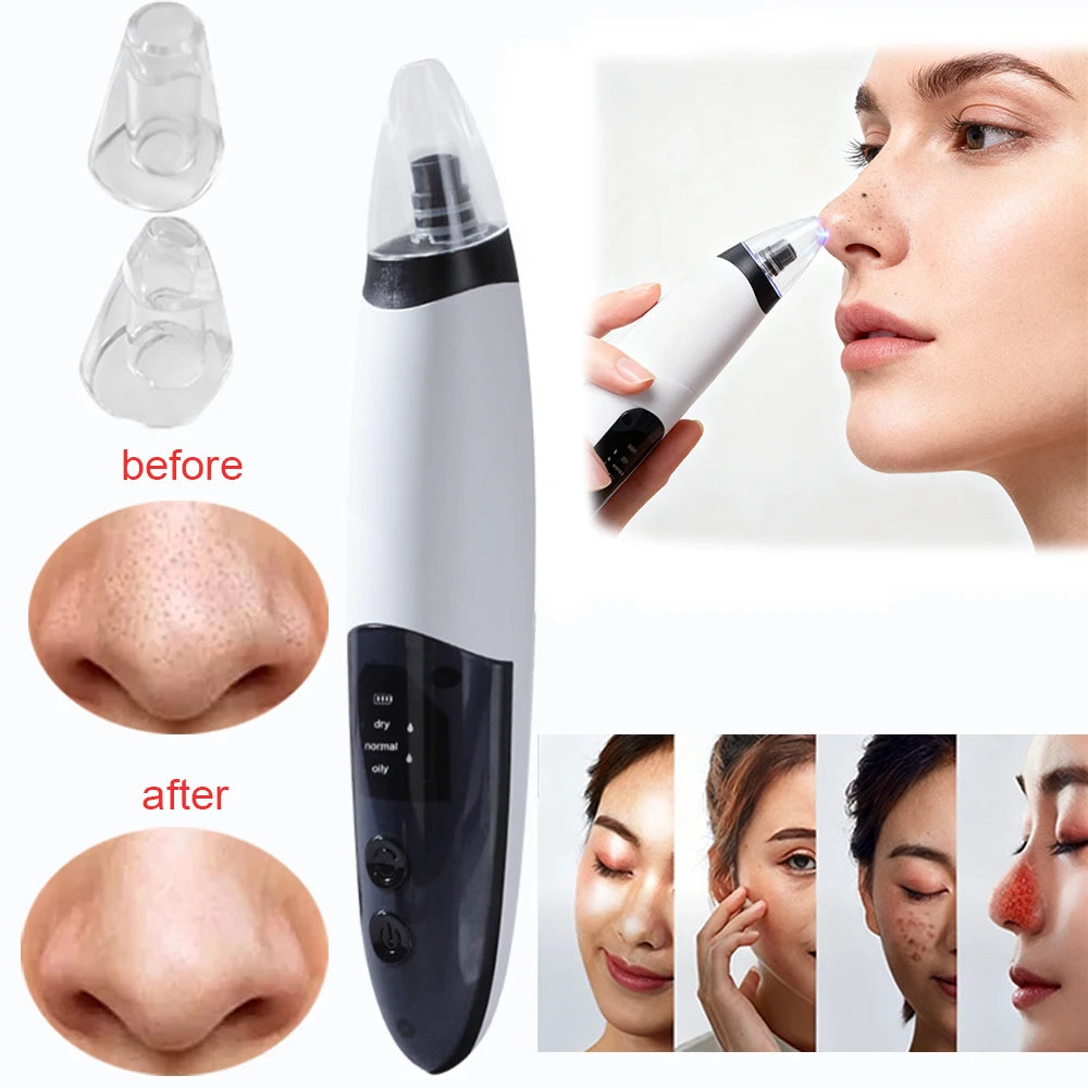 Electric Blackhead Remover Pore Vacuum – Deep Pore Cleansing & Acne Extraction Device